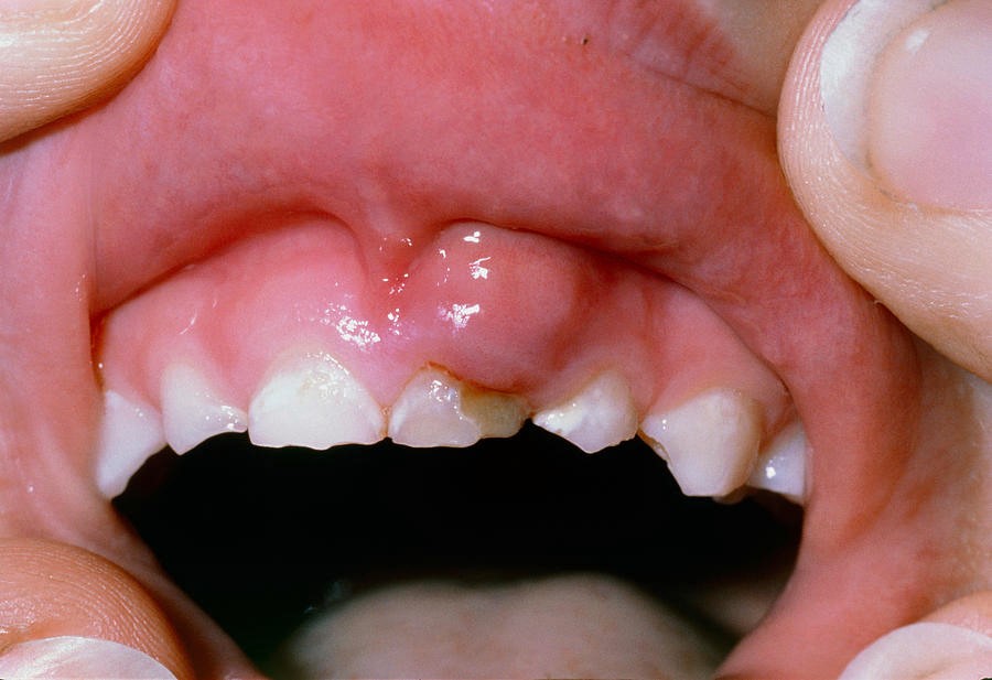 عفونت و درد دندان