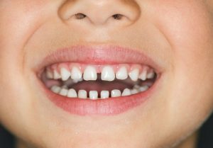 تاثیر مراقبت از دندان شیری بر دندان اصلی