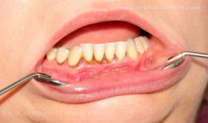 پلاک دندان چیست؟