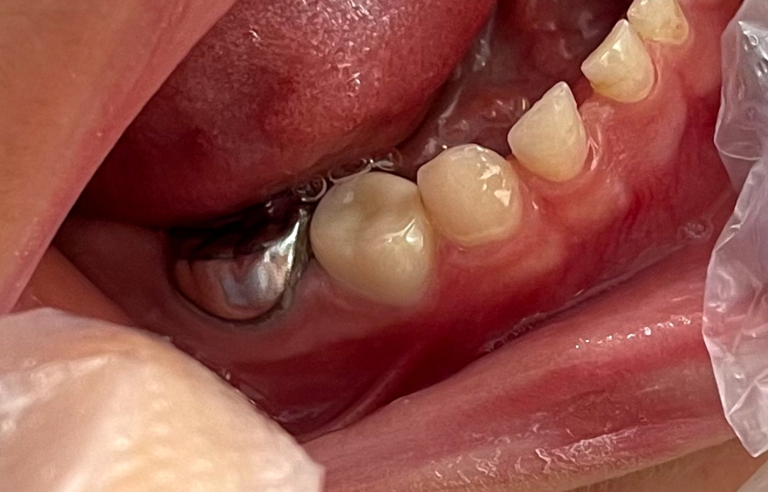 روکش دندان های شیری SSC