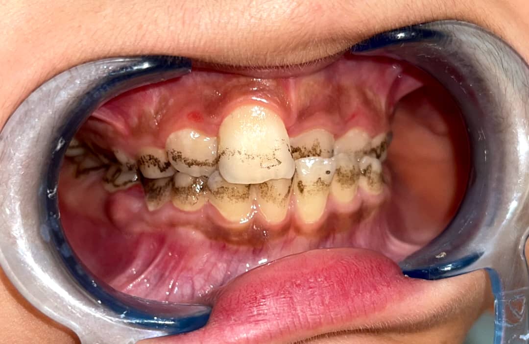 رنگدانه دندان کودکان