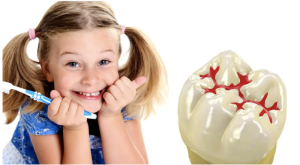 فیشور سیلانت دندان