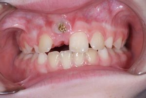 دندان نهفته در کودکان