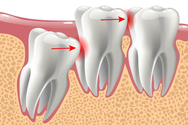 درمان دندان نهفته در کودکان 