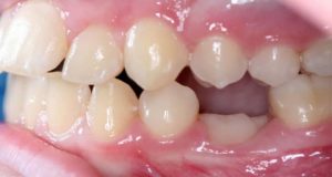 علت انکیلوز دندان کودکان