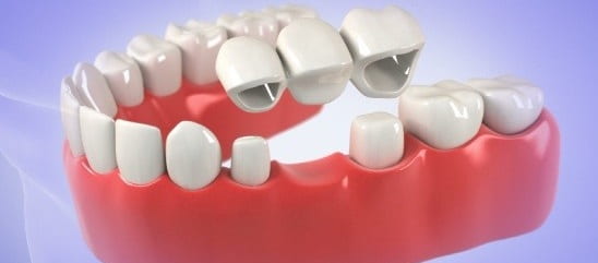 پل دندان کودکان 