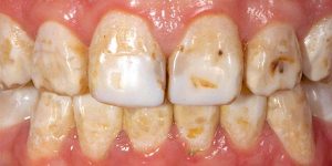 فلوروزیس دندان کودکان