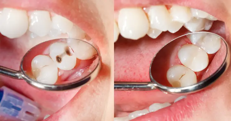 پرکردن دندان کودکان با کامپوزیت