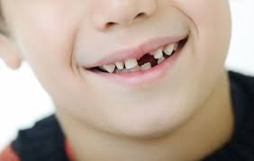 درمان دندان شکسته کودکان