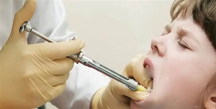 سر کردن دندان کودک