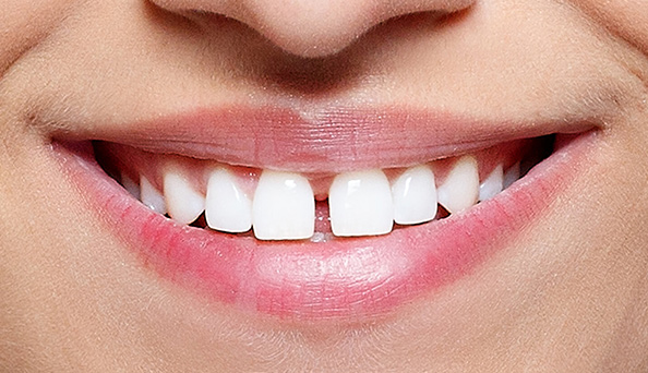 اصلاح فاصله میان دندان کودکان