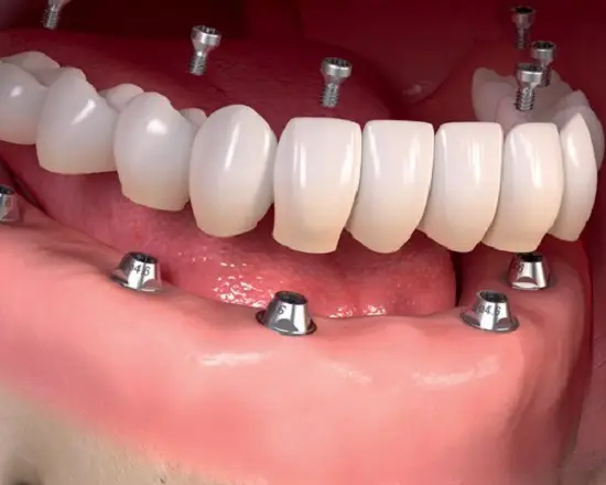 ایمپلنت دندان کودکان 