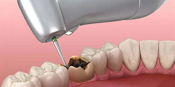 پر کردن و روکش همزمان دندان شیری