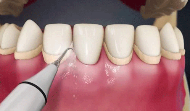 جرم گیری دندان