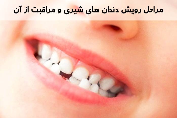 رویش دندان شیری