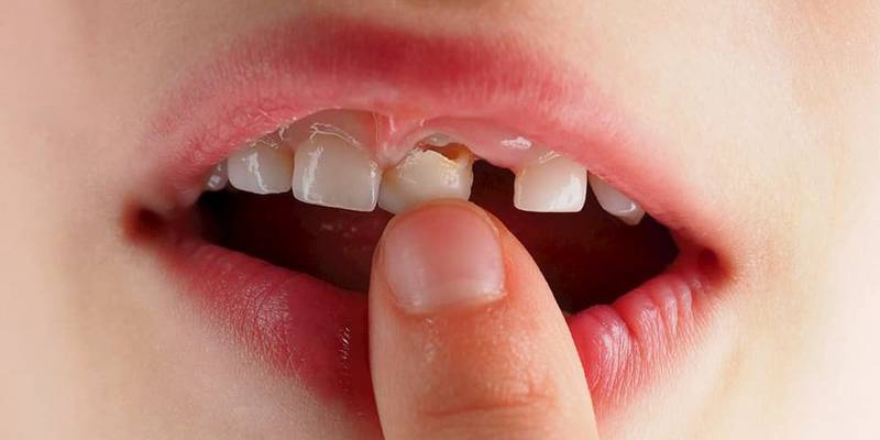 اسپلینت دندان کودکان