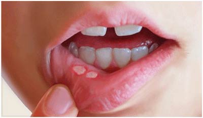 ضایعات دهانی کودکان