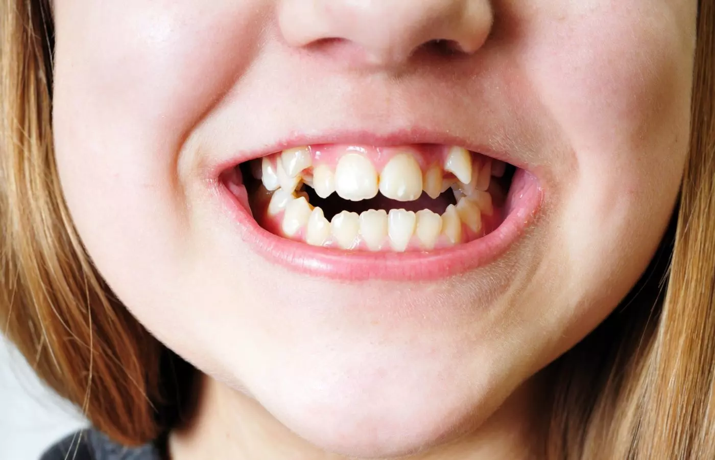 نامرتبی دندان در کودکان