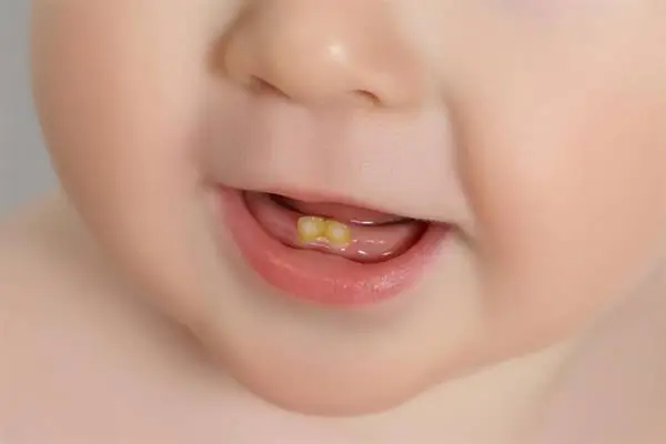 زرد شدن دندان کودک