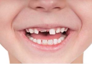 مزایای باندینگ دندان کودکان