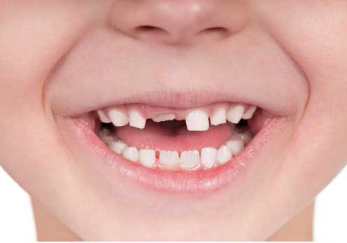 مزایای باندینگ دندان کودکان