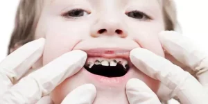 ایجاد عفونت در دندان شیری کودکان