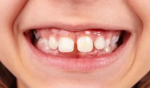 فاصله میان دندان کودک