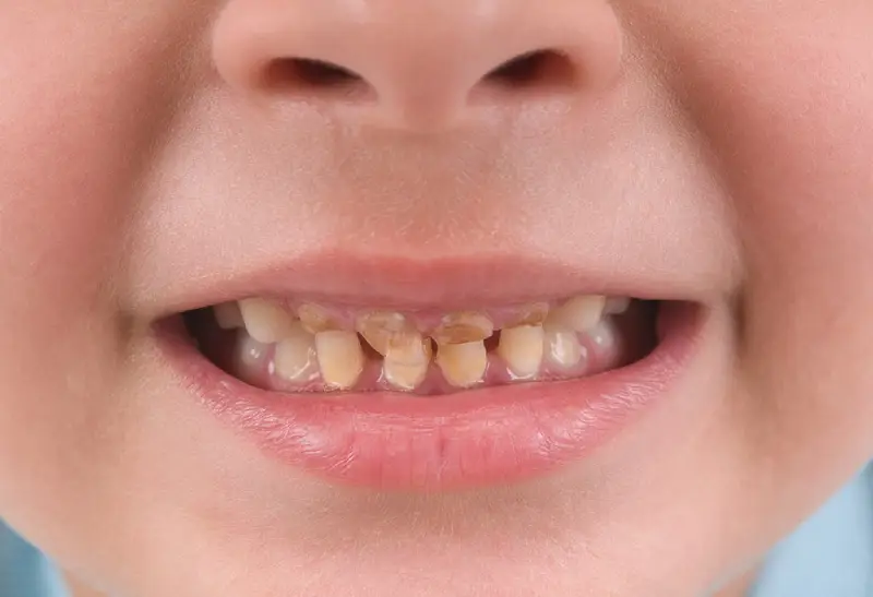 تاثیر مکمل آهن بر دندان های شیری کودکان