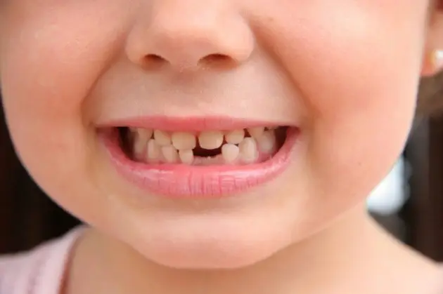 درمان رایج عدم رویش دندان های دائمی