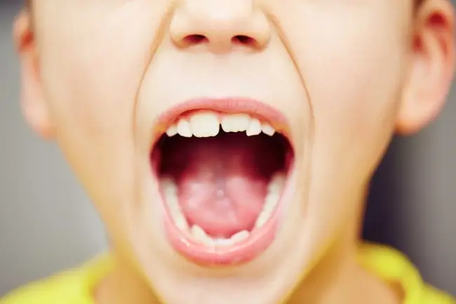 درمان نامرتبی دندان کودکان