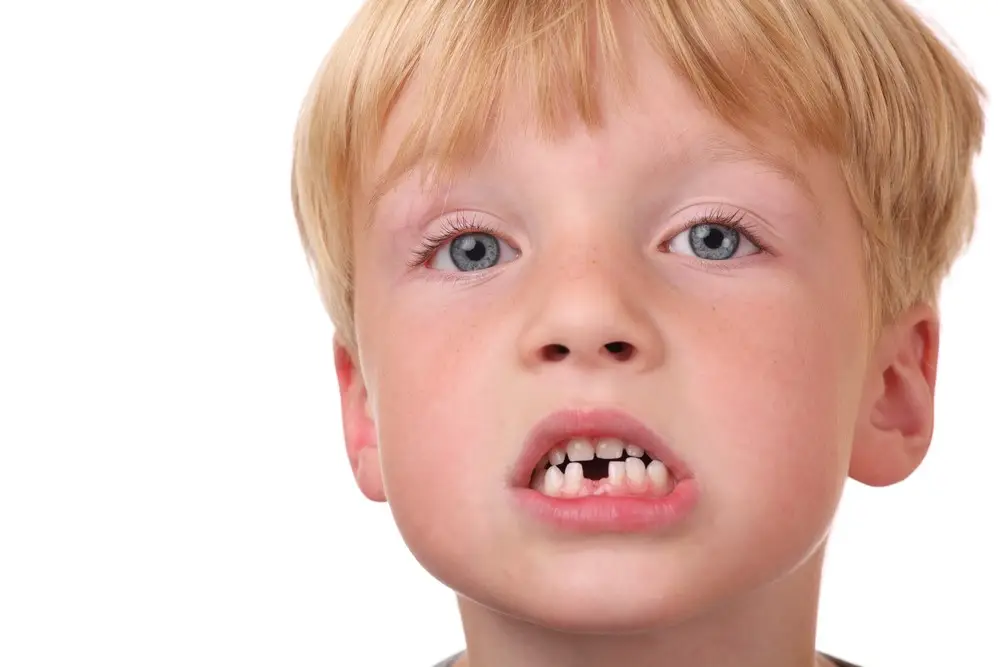 علت بیرون نیامدن دندان دائمی در کودکان