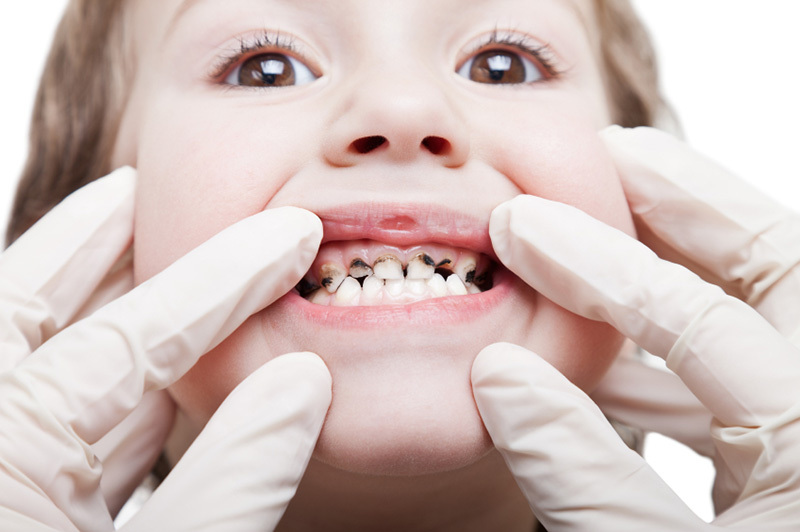 دندان در کودکان چه زمانی نیاز به درمان دارد؟