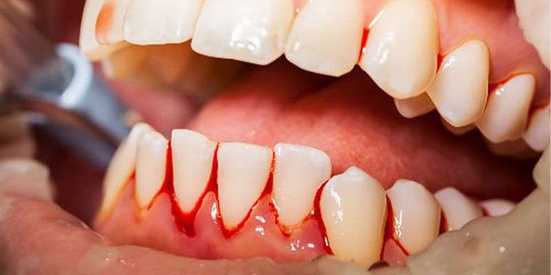 مراقبت های دهان و دندان در کودکان هموفیلی