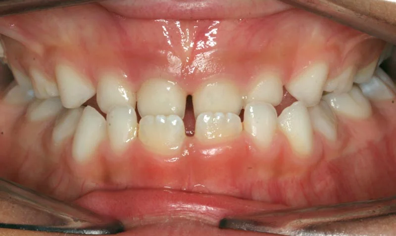 کراس بایت دندانی در کودکان