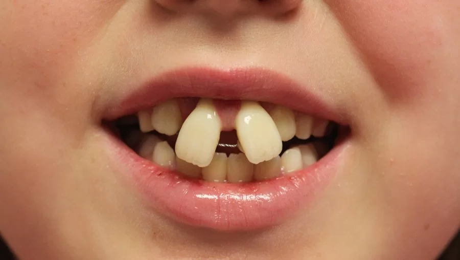 جلو زدگی دندان در کودکان