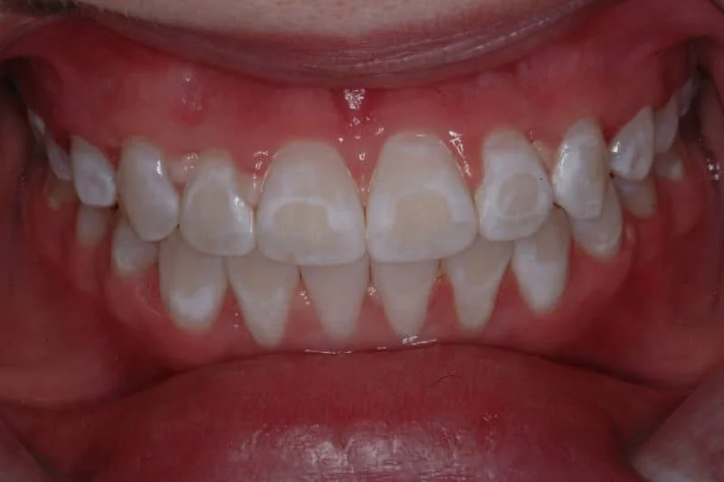 لکه های سفید روی دندان کودکان