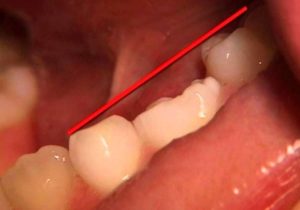 آنکیلوز دندان شیری