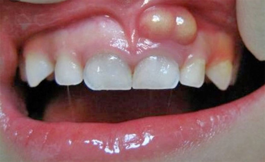 عفونت لثه و آبسه دندانی