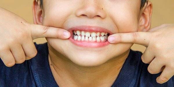 علل پوسیدگی زودرس دندان در شیرخوارگی