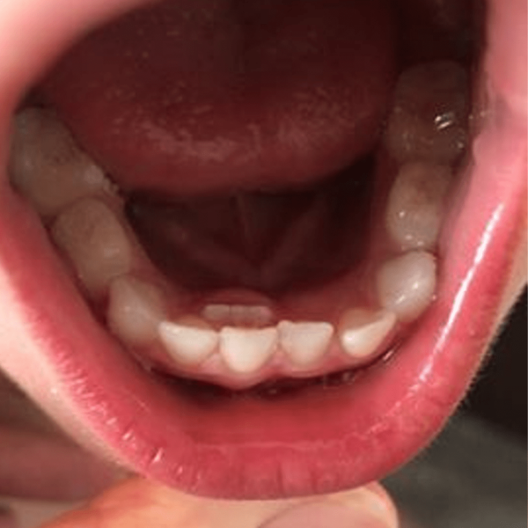دندان دائمی پشت دندان شیری