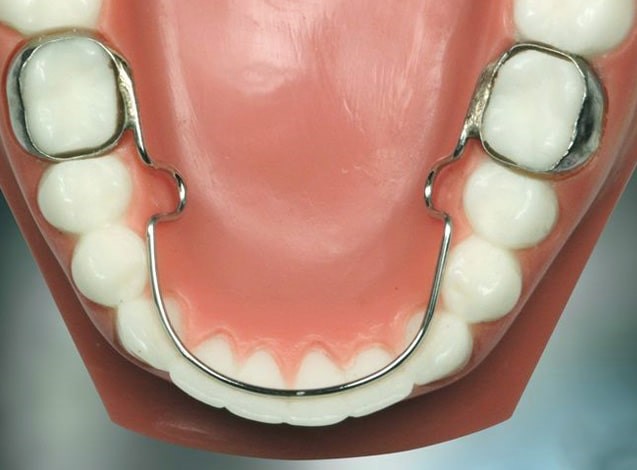 فضا نگهدارنده دندان