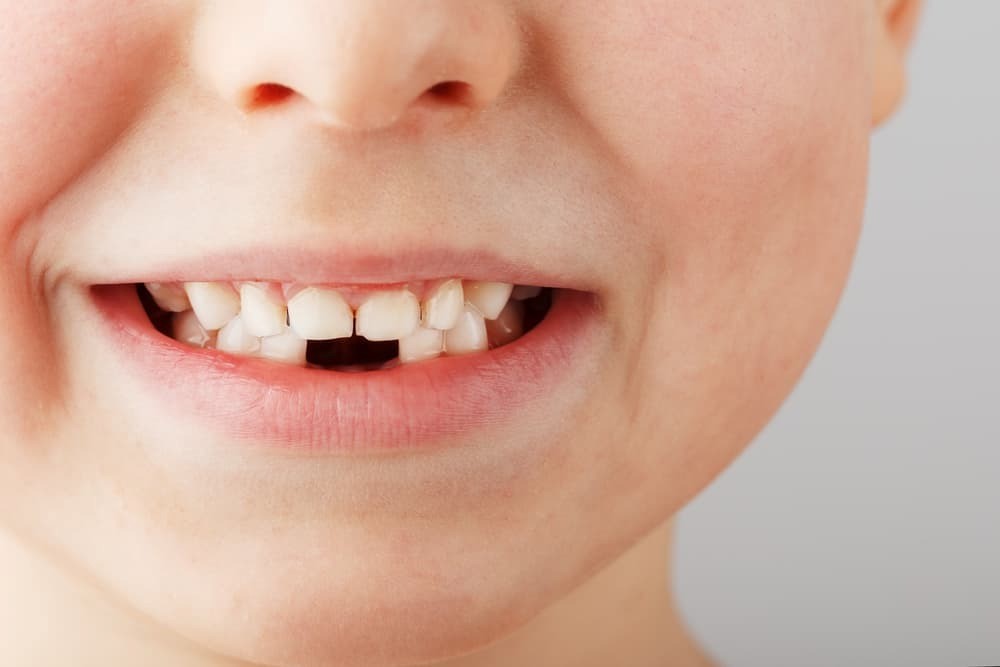 لق شدن دندان دائمی کودکان