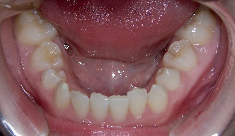 Baby Tooth Occlusion