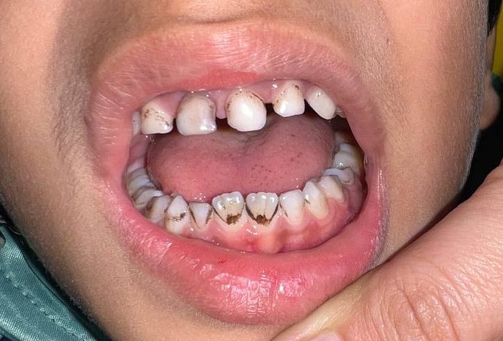 سیاهی دندان کودکان توسط قطره آهن