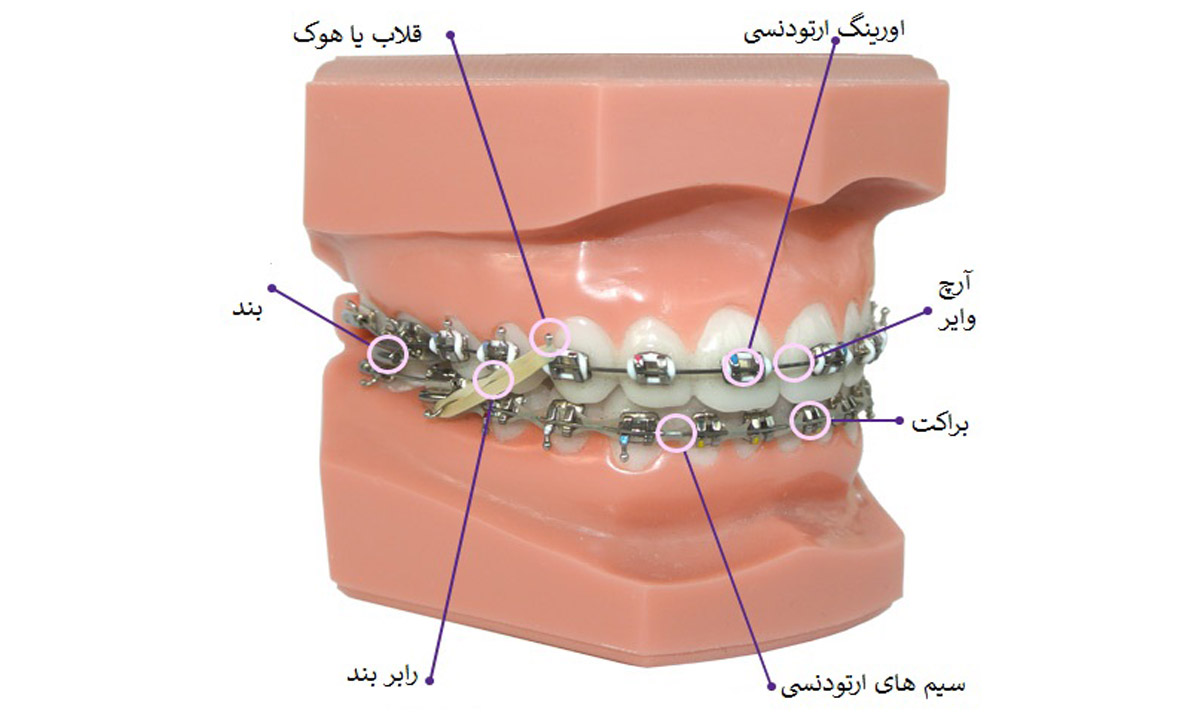 آشنایی با اصطلاحات رایج ارتودنسی