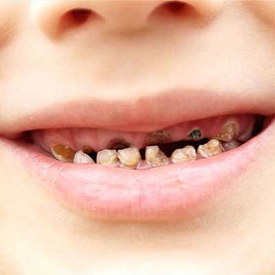 درمان پوسیدگی دندان کودک 3 ساله