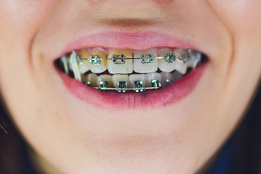 زرد شدن دندان‌ها بعد از اتمام ارتودنسی در کودکان