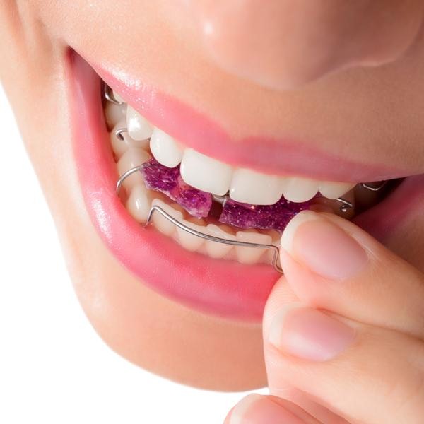 علت برگشت دندان بعد از ارتودنسی