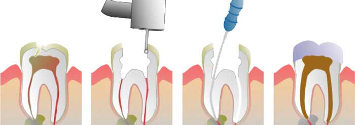 نحوه درمان عفونت دندان عصب کشی شده