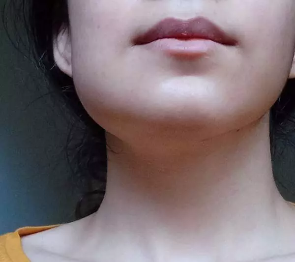 دلایل ورم کردن صورت بعد از ایمپلنت دندان